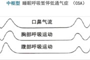 关于睡眠呼吸暂停综合症严重程度分级的信息