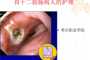 十二指肠溃疡的症状及表现,十二指肠溃疡的症状