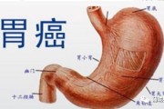 胃溃疡症状表现有哪些胃溃疡症状表现有哪些用什么药