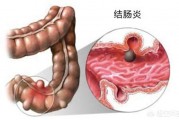 结肠炎与普通肠炎有什么区别？