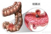 结肠炎与普通肠炎有什么区别？