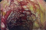 结肠炎的症状及治疗时间一般多长结肠炎的症状及治疗