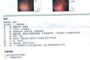 什么叫慢性浅表性胃炎慢性浅表性胃炎