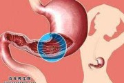 胃溃疡的症状及治疗猪胃溃疡的症状及治疗