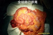 结肠腺癌,结肠腺癌手术治愈率