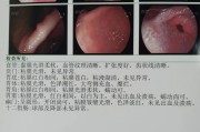 红斑渗出性胃炎十二指肠球炎十多年了,不吃药能自愈吗? 红斑渗出性胃炎十二指肠球炎十多年了,不吃药能自愈吗?