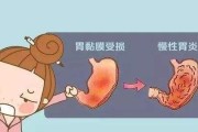 慢性胃炎最多能活几年慢性胃炎症状