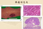 直肠息肉直肠息肉的早期症状