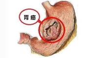 胃息肉胃息肉怎么治疗才消除