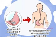 幽门螺旋杆菌症状,幽门螺旋杆菌症