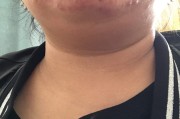 下颚长痘下颚线长痘什么原因