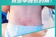 吸入甲醛会有什么症状,宝宝吸入甲醛会有什么症状