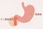 什么是消化性溃疡? 什么是消化性溃疡?