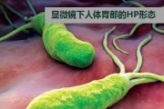 幽门螺旋杆菌最佳治疗方案的简单介绍