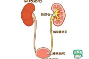 肾结石最快自愈方法,肾结石