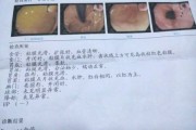 慢性非萎缩性胃炎是什么意思,慢性萎缩性胃炎吃什么药可以根治 慢性非萎缩性胃炎是什么意思,慢性萎缩性胃炎吃什么药可以根治