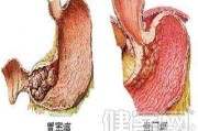 贲门失弛缓症,贲门
