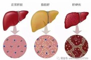 肝脏功能下降怎么办肝脏功能