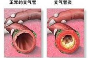 气管炎都有哪些症状,气管炎