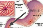 查出十二指肠溃疡,服药二个月,为什么还有黑便? 查出十二指肠溃疡,服药二个月,为什么还有黑便?