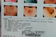 barrett食管,barrett食管的症状