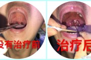 咽炎治疗咽炎治疗的有效方法
