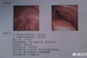慢性胃炎是什么?有何引起?如何治疗? 慢性胃炎是什么?有何引起?如何治疗?
