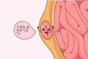 疝气,疝气手术
