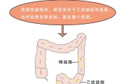 慢性肠炎症状慢性肠炎症状表现有哪些
