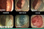 怎么确认是不是直肠癌,直肠癌早期症状