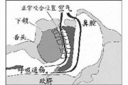 睡眠呼吸暂停综合症有什么症状原因睡眠呼吸暂停综合症有什么症状