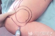 手术吸脂减肥的简单介绍