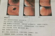 十二指肠炎,十二指肠炎能自愈吗 十二指肠炎,十二指肠炎能自愈吗