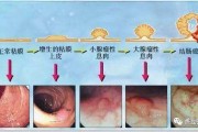 肠息肉症状及表现,肠息肉