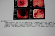 胃窦炎和胃炎哪个严重胃窦炎 胃窦炎和胃炎哪个严重胃窦炎
