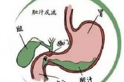如果一个人患有由胆汁反流造成的胃炎,你觉得吃什么药好? 如果一个人患有由胆汁反流造成的胃炎,你觉得吃什么药好?
