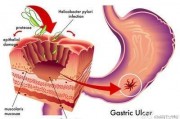 胃溃疡为什么那么难治愈，吃什么对胃溃疡痊愈有帮助呢？