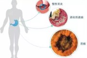 关于幽门螺旋杆菌的症状会自愈吗的信息