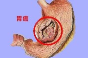 判断胃癌最简单方法胃癌早期有三处痛