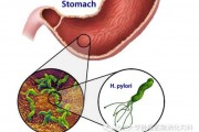 幽门螺旋杆菌阳性有必要治疗吗国外的简单介绍