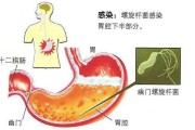 幽门螺旋杆菌怎么筛查,幽门螺旋杆菌怎么得上的