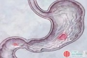 胃窦炎的症状及治疗胃窦炎严重吗 胃窦炎的症状及治疗胃窦炎严重吗