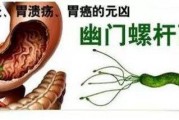 幽门螺旋杆菌的正常值范围,幽门螺杆菌结果840严重吗