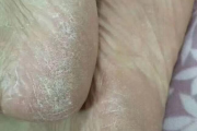 睡觉晚上老是脚底出汗晚上睡觉脚底出汗什么情况