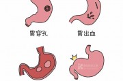 胃癌最明显的一个征兆,胃炎与胃癌自我辨别