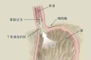 反流性食管炎如何彻底根治,反流性食管炎