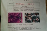 幽门螺旋杆菌阳性最佳治疗方案的简单介绍