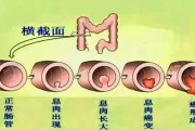 息肉,为什么会长息肉 息肉,为什么会长息肉