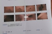十二指肠球部溃疡有哪些症状,十二指肠球部溃疡
