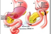 胆汁反流性胃炎,胆汁反流性胃炎症状表现有哪些